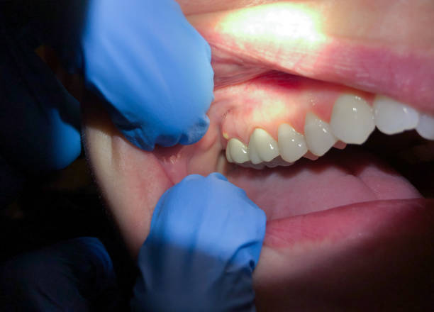 Best Knocked-Out Tooth Emergency  in Bushland, TX
